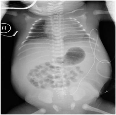 Case Report: Neonatal Urinary Ascites Without Hydronephrosis: A Rare Case of Anterior Urethral Valve and Diverticulum in Preterm Newborn